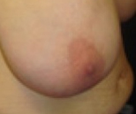 Large areola before breast surgery